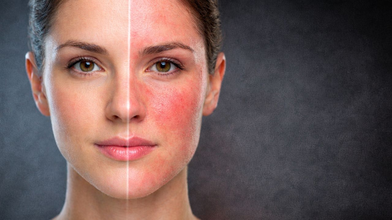 Rosacea Ternyata Lebih Kompleks dari Sekadar Wajah Merah, Ini Fakta Terbarunya